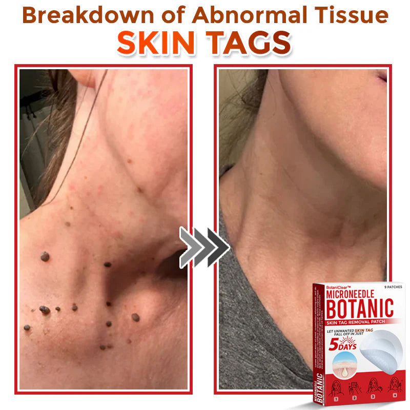 🌿 BotaniClear™ USA-Made MicroNeedle Patch for Skin Tags | Natural Removal in Just 5 Days