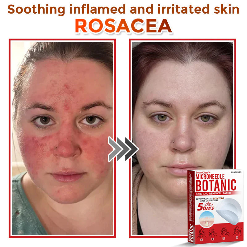 🌿 BotaniClear™ USA-Made MicroNeedle Patch for Skin Tags | Natural Removal in Just 5 Days