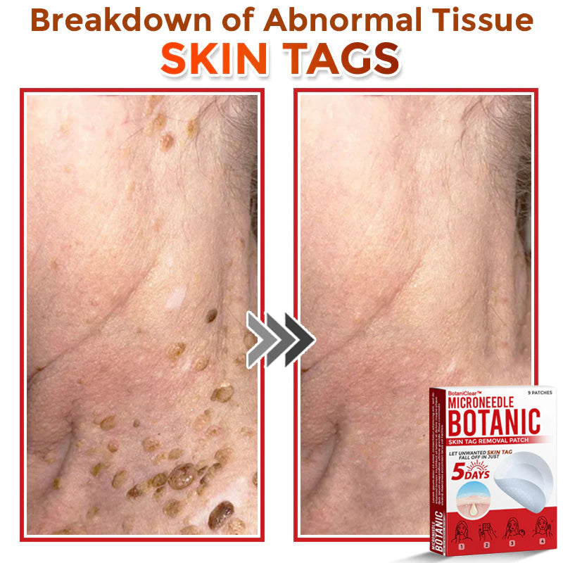 🌿 BotaniClear™ USA-Made MicroNeedle Patch for Skin Tags | Natural Removal in Just 5 Days