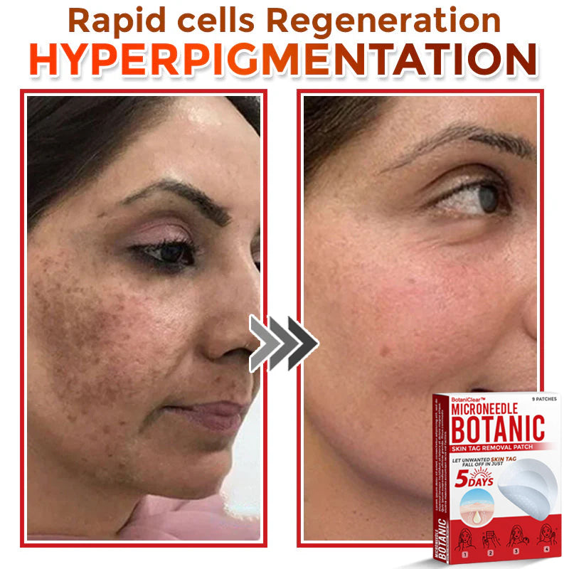 🌿 BotaniClear™ USA-Made MicroNeedle Patch for Skin Tags | Natural Removal in Just 5 Days