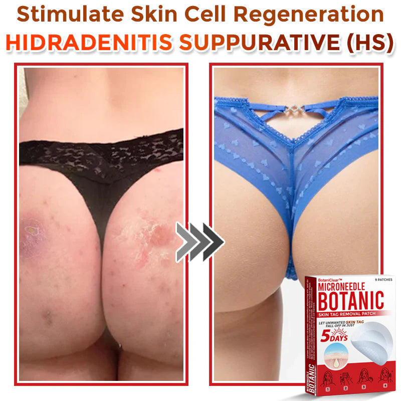 🌿 BotaniClear™ USA-Made MicroNeedle Patch for Skin Tags | Natural Removal in Just 5 Days