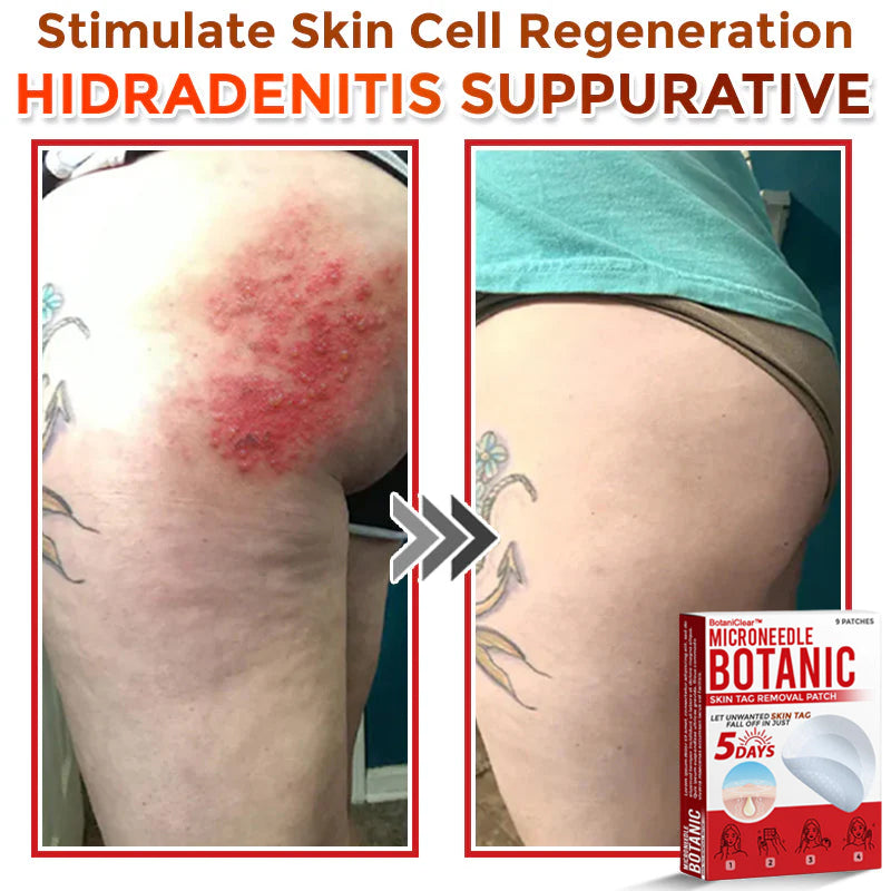 🌿 BotaniClear™ USA-Made MicroNeedle Patch for Skin Tags | Natural Removal in Just 5 Days