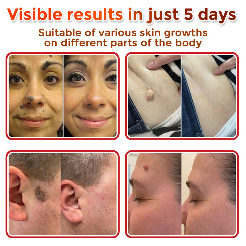 🌿 BotaniClear™ USA-Made MicroNeedle Patch for Skin Tags | Natural Removal in Just 5 Days