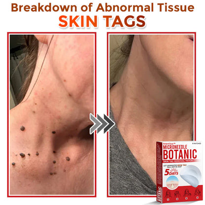 🌿 BotaniClear™ USA-Made MicroNeedle Patch for Skin Tags | Natural Removal in Just 5 Days